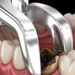 What to Expect During Wisdom Tooth Extraction